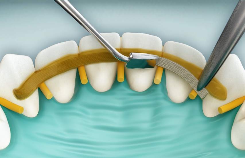 imobilizarea parodontala