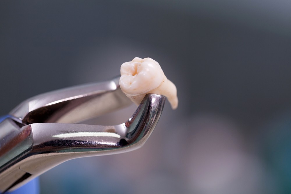 extractie masea minte bistrita, chirurgie dentara bistrita, extractii dentare bistrita, neomedica or