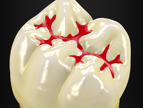 sigilarea dentara, sigilarea santurilor si fosetelor