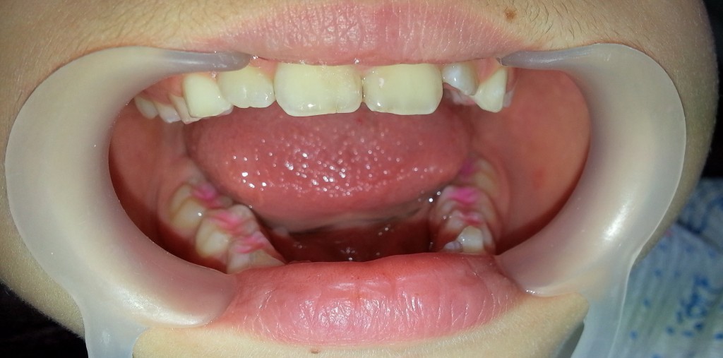 sigilarea dentara, sigilarea santurilor si fosetelor