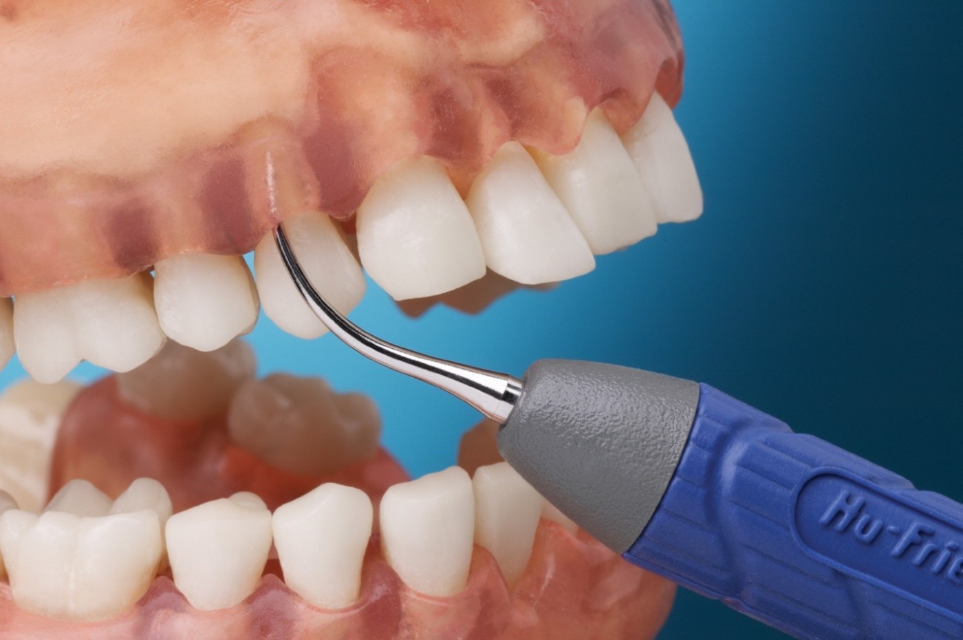 detartrajul supragingival, detartrajul subgingival, detartraj