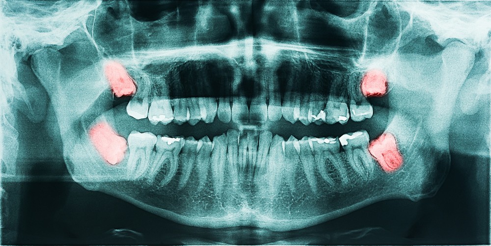extractie masea minte bistrita, chirurgie dentara bistrita, extractii dentare bistrita, neomedica or